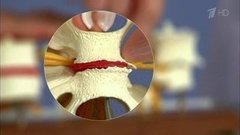 Вопросы о боли в спине. Остеохондроз. Здоровье. Фрагмент выпуска от 17.04.2016