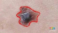 Родинки и солнце. Жить здорово! Фрагмент выпуска от 16.05.2018