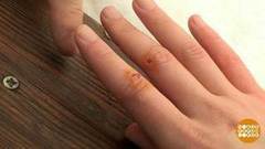 Йод и сахар на рану. Доброе утро. Фрагмент выпуска от 24.01.2017