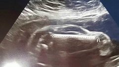 УЗИ беременной: мальчик, девочка или… машина?! Хиты интернета