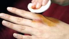 Лечим дерматит. Доброе утро. Фрагмент выпуска от 18.11.2016