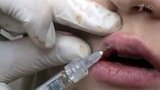 В Кирове накрыли преступную группу, которая торговала фальшивым ботоксом
