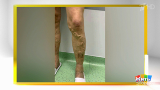 Варикоз: зима — твой союзник? Жить здорово! Фрагмент