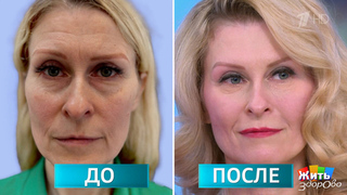 Глаза на 10 лет моложе: правда или косметический трюк? Жить здорово! Фрагмент