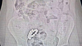 Проглотившего 19 магнитов мальчика спасли московские врачи