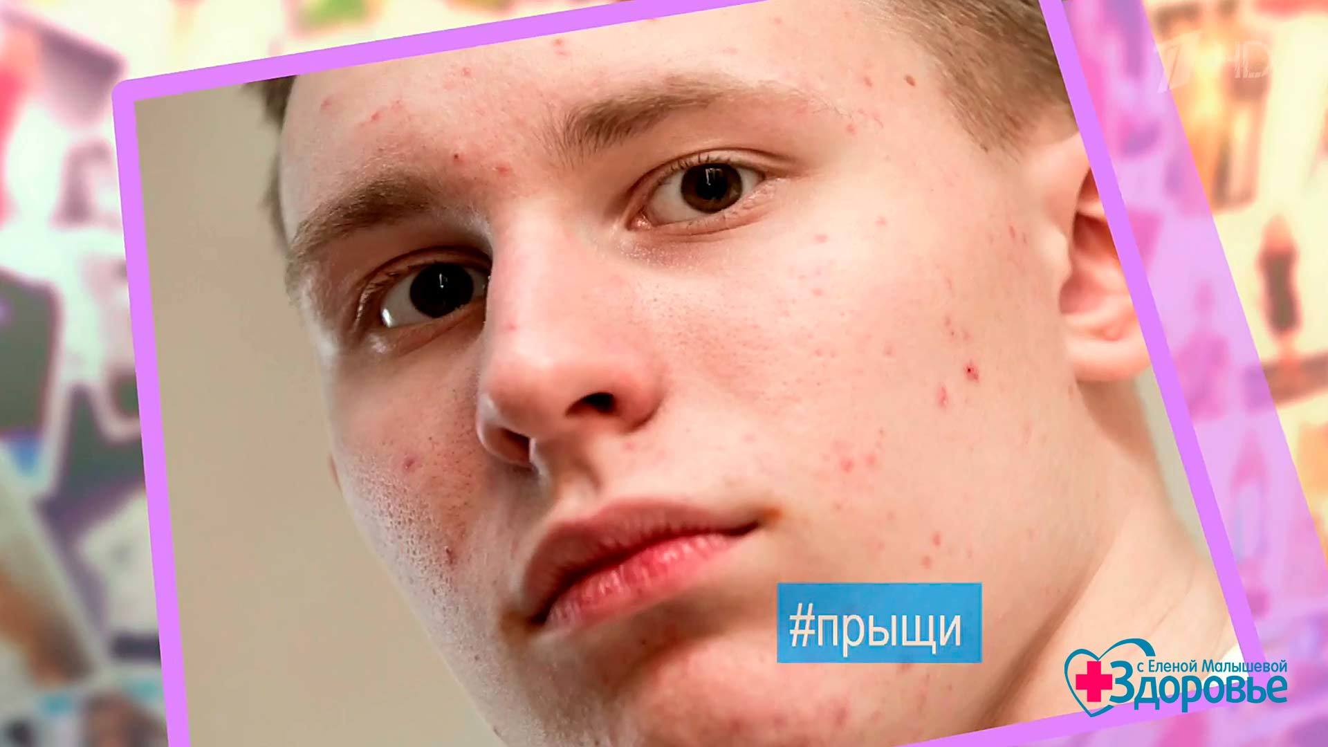 Одолели прыщи только на лице Одолели прыщи только на лице