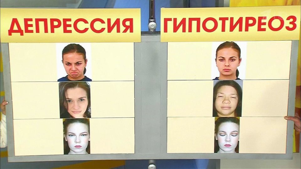 Как выглядит лицо при гипотиреозе Депрессия и гипотиреоз. Жить здорово! Фрагмент выпуска от 12.04.2016