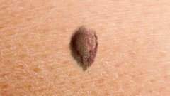 Опасные родинки. Доброе утро. Фрагмент выпуска от 06.08.2015