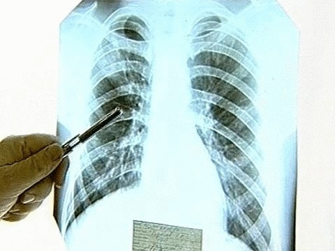 Профилактика туберкулеза