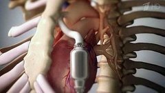 Достижения медицины. Замена левого желудочка сердца. Здоровье. Фрагмент выпуска от 20.09.2015