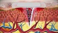 Изобретения студентов-медиков. Ранозаживляющая повязка. Здоровье. Фрагмент выпуска от 01.07.2018