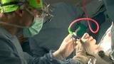 В Нижнем Новгороде врачи-нейрохирурги успешно провели «операцию с пробуждением» пациентке с опухолью мозга