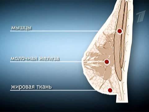 Разрыв импланта молочных желез фото