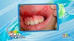 Афтозный стоматит. Жить здорово! Фрагмент выпуска от 07.02.2018