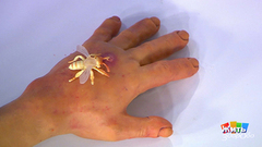 Укус осы — опасные последствия. Жить здорово! Фрагмент выпуска от 27.04.2018