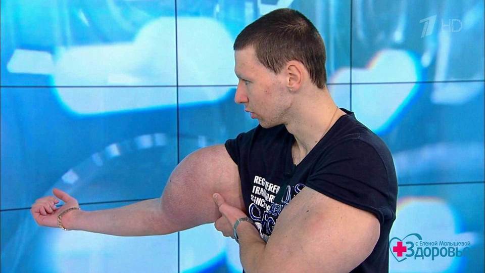«Руки-базуки». Как помочь Кириллу Терешину? Здоровье. Фрагмент выпуска от 09.09.2018