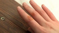 Лечим порез. Доброе утро. Фрагмент выпуска от 11.03.2016