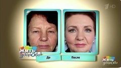 Химический пилинг. Жить здорово! Фрагмент выпуска от 07.06.2017