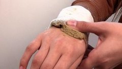 Как предотвратить отек при ушибе