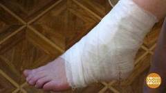 Лечим растяжение. Доброе утро. Фрагмент выпуска от 16.05.2017