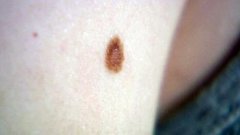 Родинки — пора избавляться. Доброе утро. Фрагмент выпуска от 16.02.2015