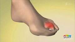 Боль в ногах. Неврома Мортона. Жить здорово! Фрагмент выпуска от 15.05.2019