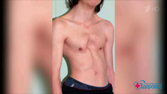 «Грудь сапожника»: деформация грудной клетки у детей. Здоровье. Фрагмент выпуска от 09.07.2017