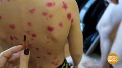 Семь вопросов о ветрянке. Доброе утро. Фрагмент выпуска от 19.11.2019