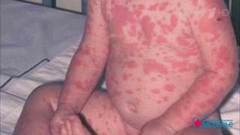 Синдрома Лайелла. Смертельная аллергия у детей. Здоровье. Фрагмент выпуска от 12.01.2020