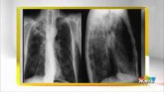Мифы и правда про туберкулез. Жить здорово! Фрагмент выпуска от 24.03.2020