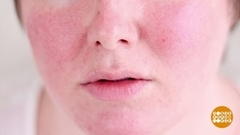 Аллергия на холод. Доброе утро. Фрагмент