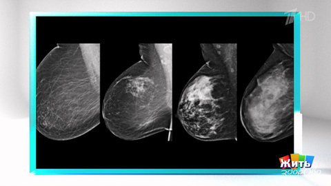Анализ риска рака груди: что делать дальше? Фрагмент 