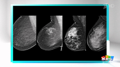 Анализ риска рака груди: что делать дальше? Фрагмент 