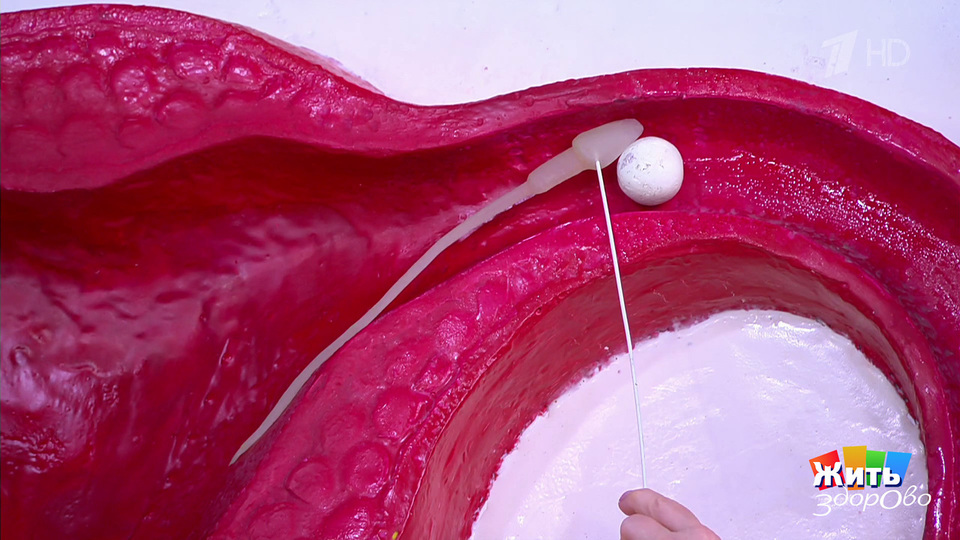 Таблетка, что изменила секс: свобода и лечение в одной упаковке. Жить здорово! Фрагмент выпуска от 04.12.2025