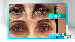 Грыжи век: кто прав — офтальмолог или пластический хирург? Жить здорово! Фрагмент 