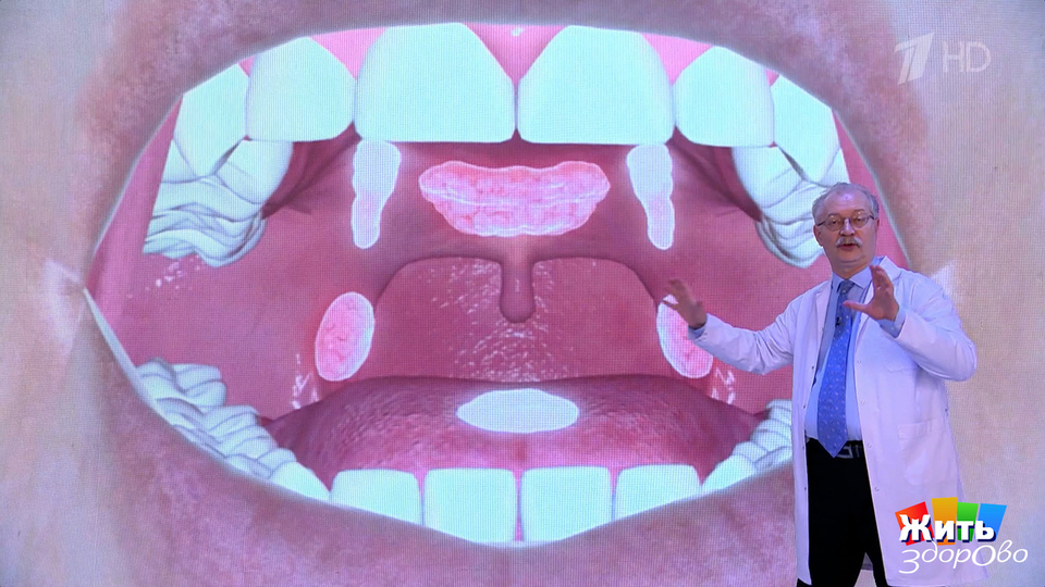 Ангина: лечим правильно — без осложнений. Жить здорово! Фрагмент выпуска от 30.01.2026