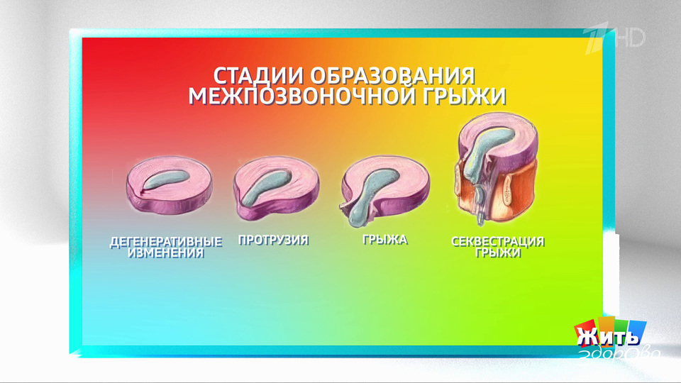 Прострел: когда тело предупреждает? Жить здорово! Фрагмент выпуска от 03.02.2026