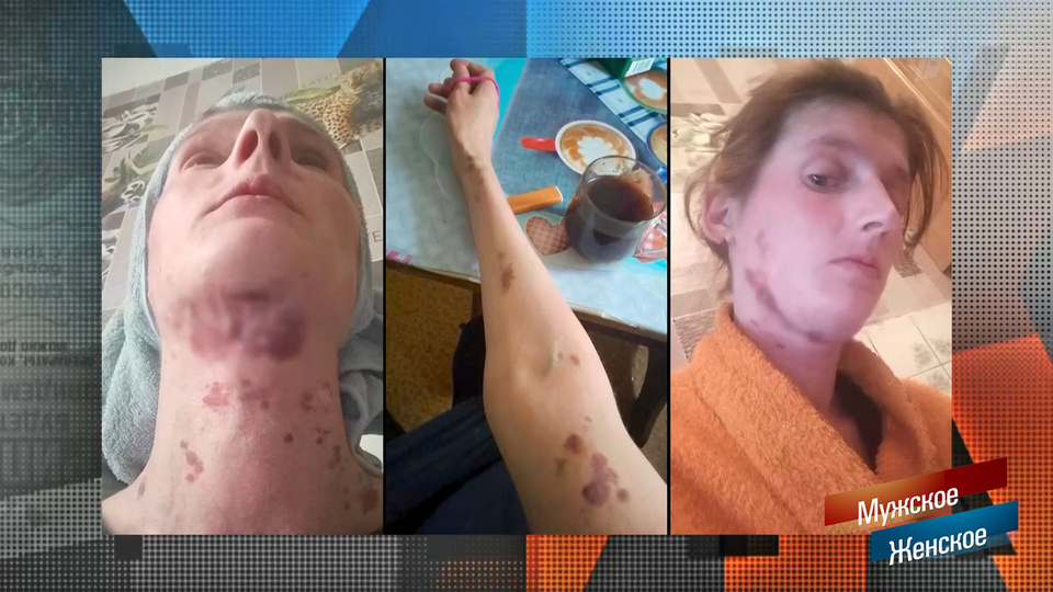 «У нее кожа нежная». Мужчина объяснил происхождение синяков на лице своей бывшей жены. Мужское / Женское. Фрагмент выпуска от 05.02.2026