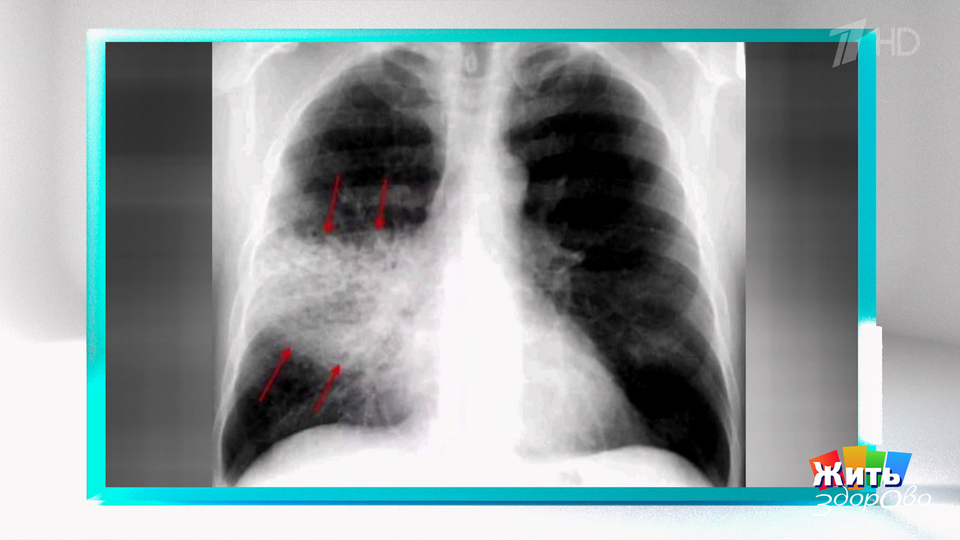 Пневмония: красный уровень. Жить здорово! Фрагмент выпуска от 06.02.2026