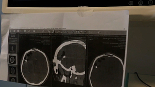 Хирурги удалили осколок из мозга бойца СВО с помощью «умных» очков
