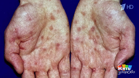 Сифилис у мужчин: скрытая угроза. Жить здорово! Фрагмент 