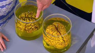 В «Жить здорово!» раскрыли, какое давление ведет к инсульту, а какое — к слабоумию