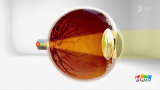 Дальнозоркость: помогут технология или врач? Жить здорово! Фрагмент 