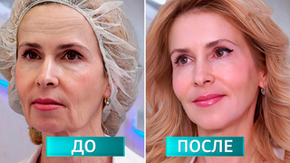 Брыли поплыли: в «Жить здорово!» рассказали о подтяжке лица без скальпеля