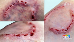 Укусы диких животных. Жить здорово! Фрагмент 